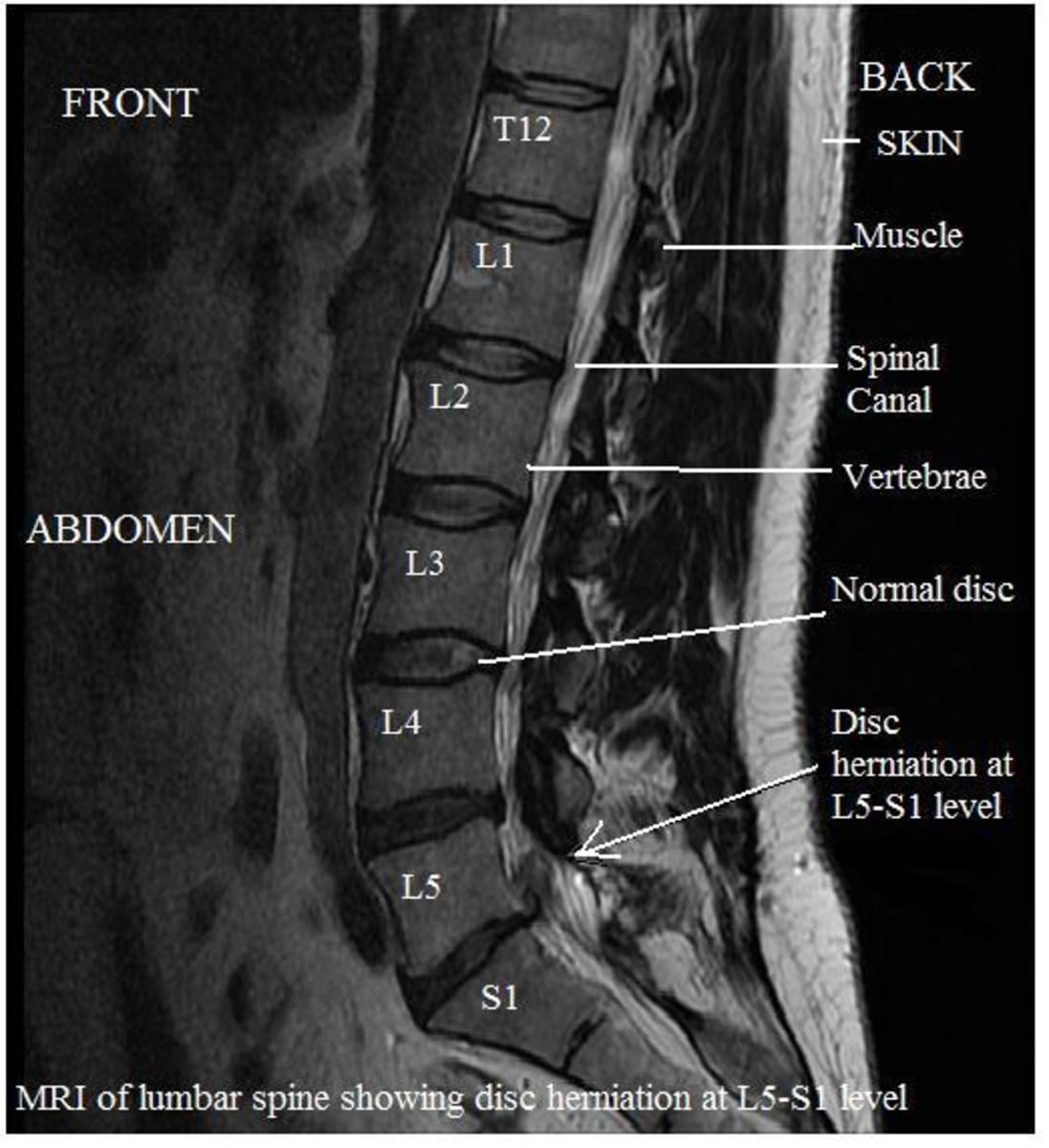 How to Treat Acute Lumbar Back Pain