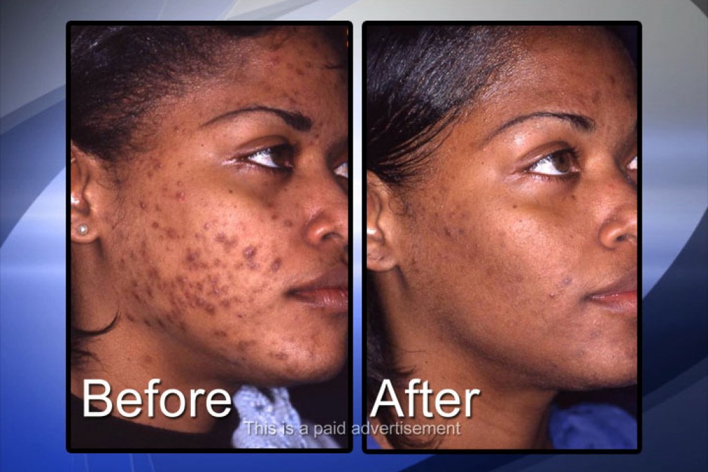 Hormonal Imbalance Acne Treatment