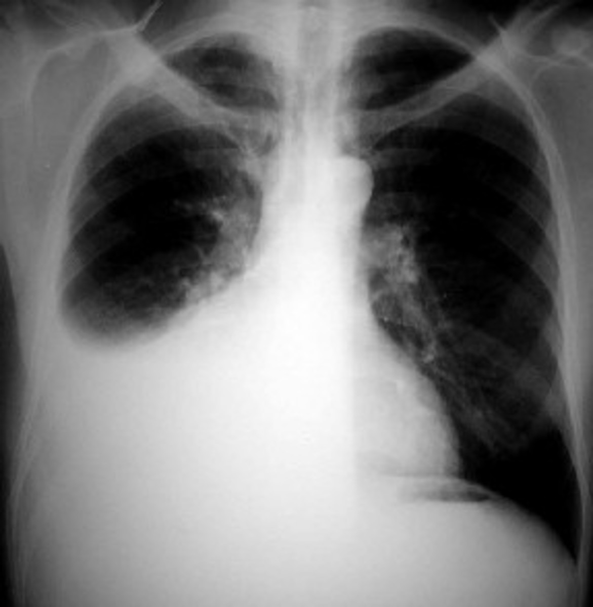 Clinical details and basic medical information about Pleurisy and