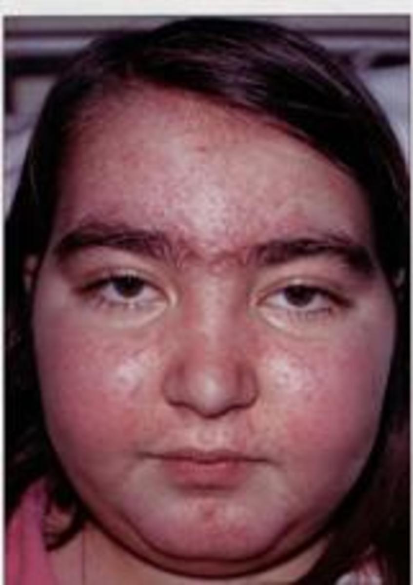 Pituitary disordersDiabetes Insipidus and Cushing's Syndrome HubPages