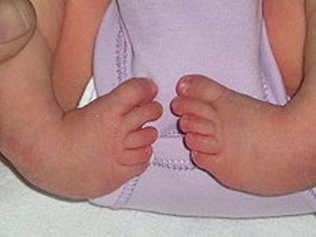 Club feet thanks to medical science clubfeet is not a curse! HubPages