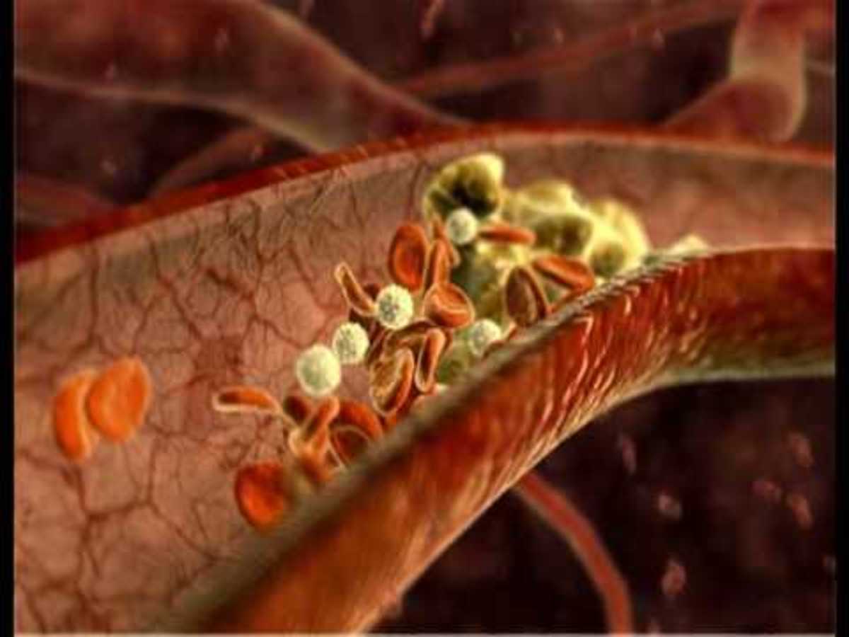 Dangerous Side Effects of Blood Thinners as Warfarin (Coumadin) hubpages