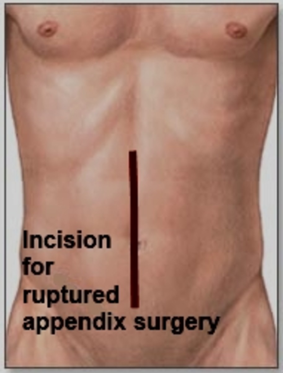 Symptoms of Appendicitis, and Ruptured Appendix....know what to look