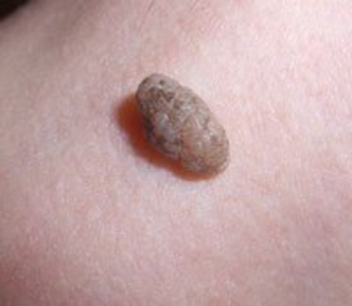 Acid For Skin Tag Removal at Jeannie Alvarez blog