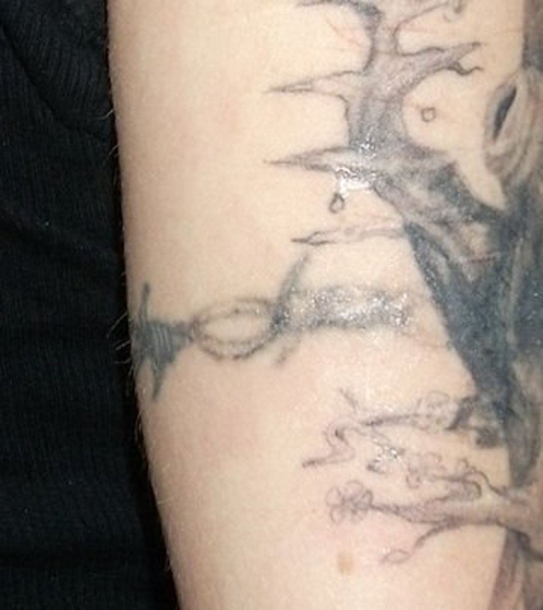 My Experience Lightening and Removing My Tattoo at Home