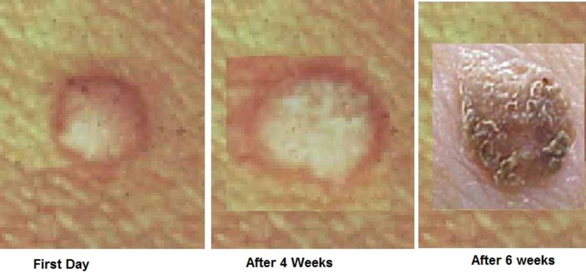 My Seborrheic Keratosis HealDove