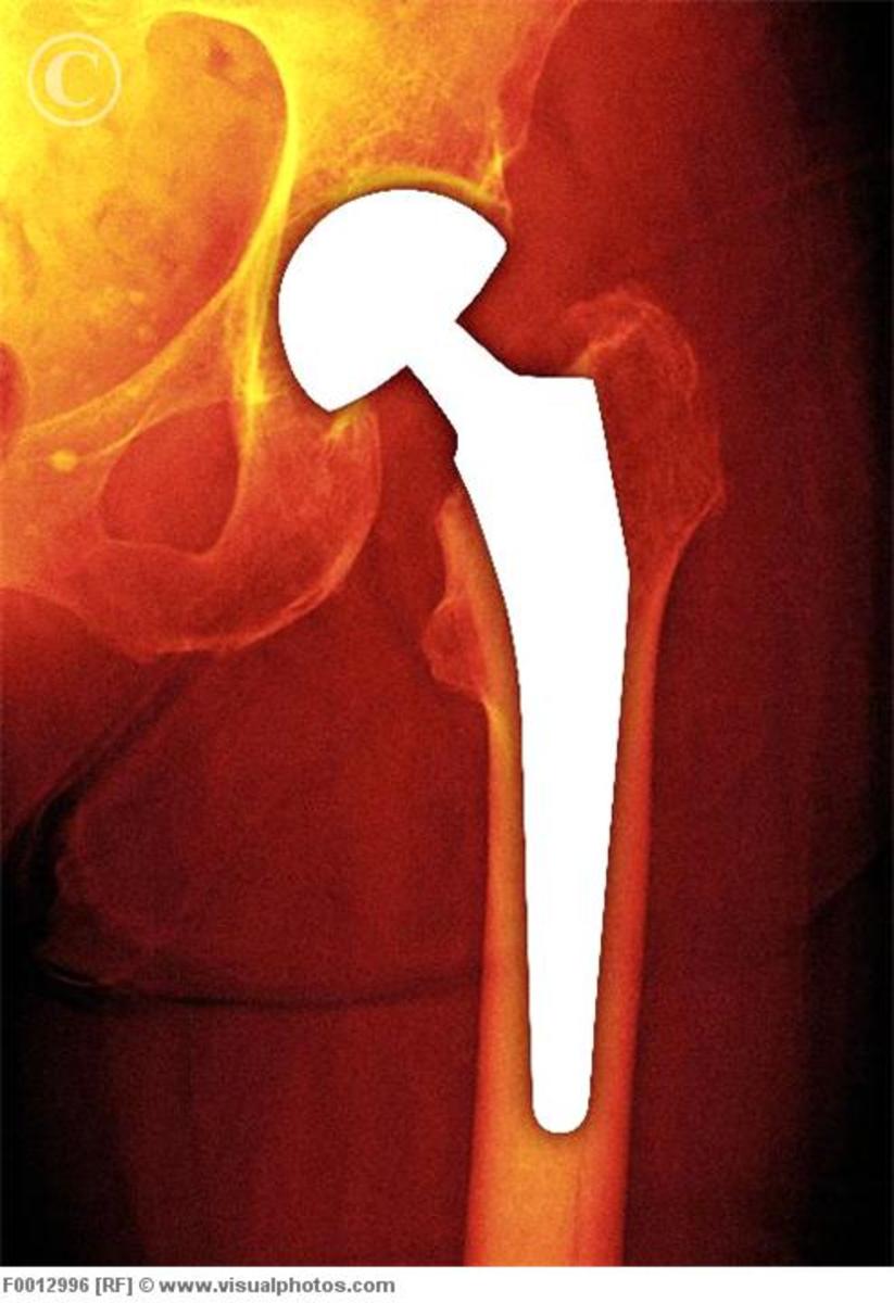 Total Hip Replacement Surgery A Survivor's Guide HubPages