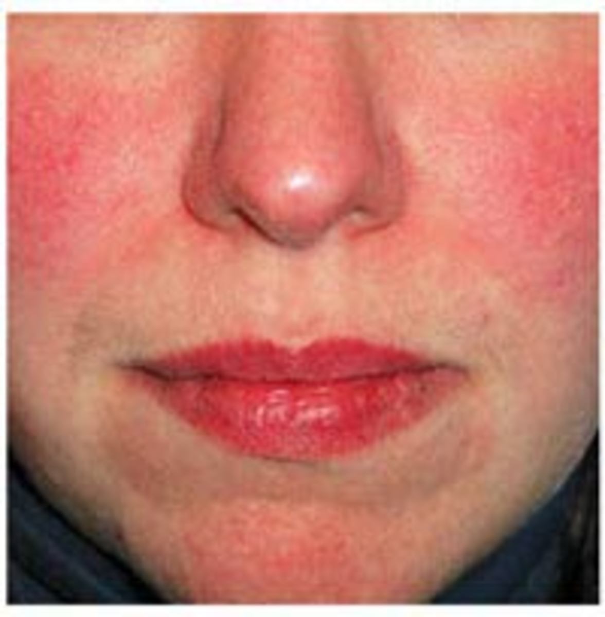 Getting Rid of Skin rash on Face Quick Tips hubpages