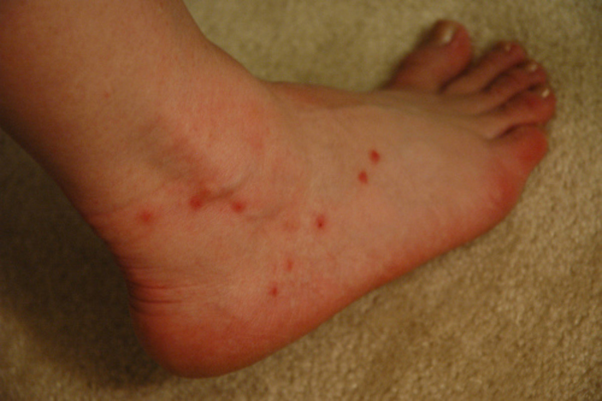 The Scottish Midge hubpages