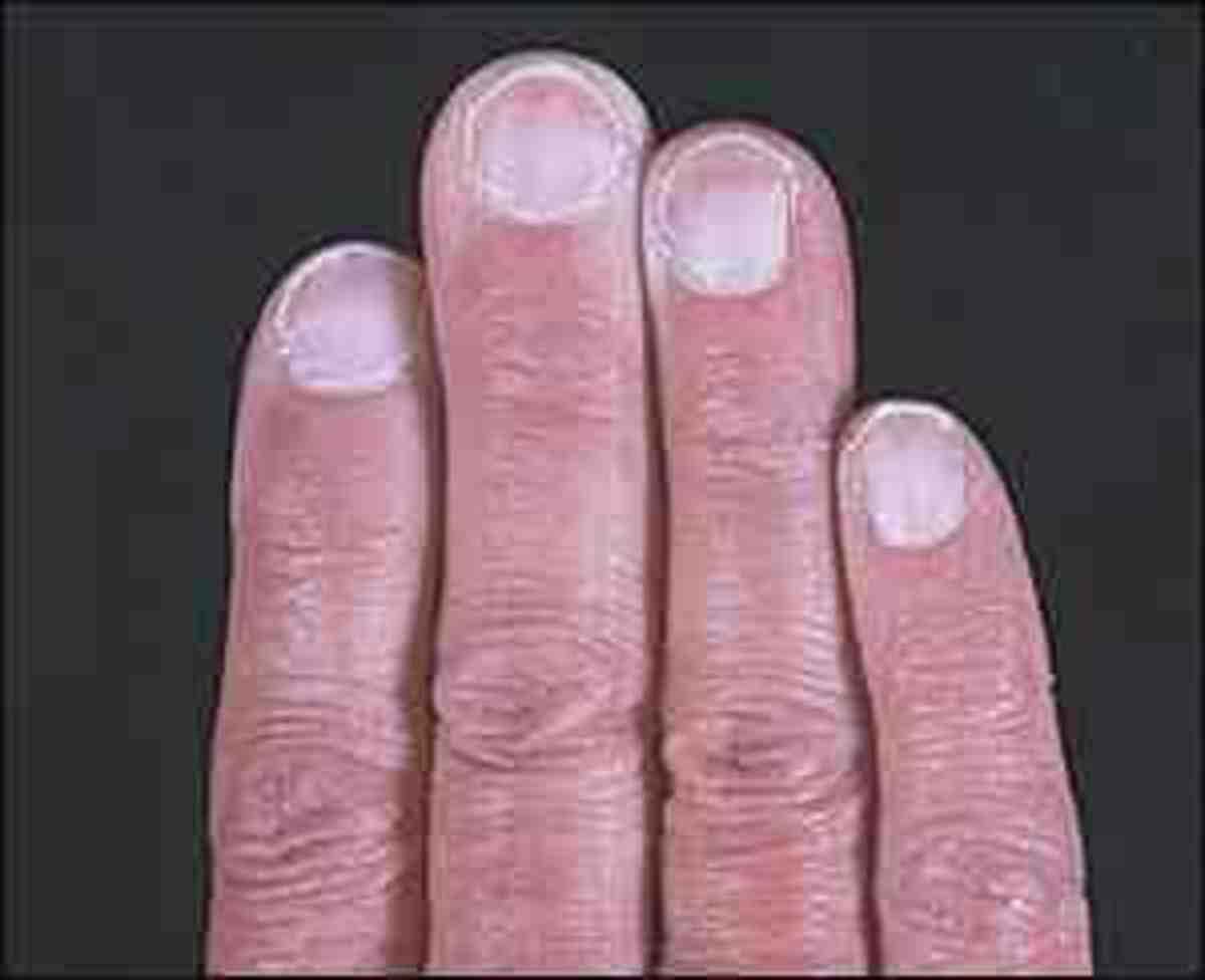 What Causes Pale Fingernails at Floyd Smith blog