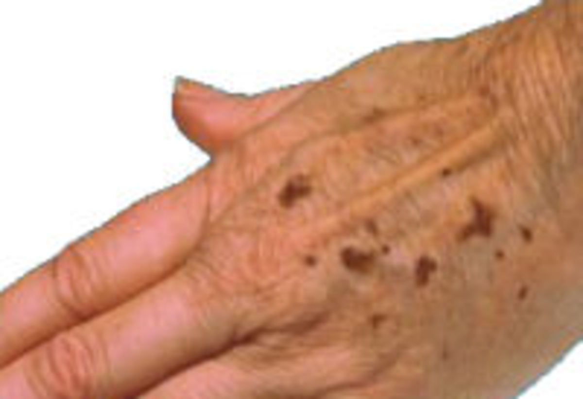 How to get rid of age spots naturally. HubPages