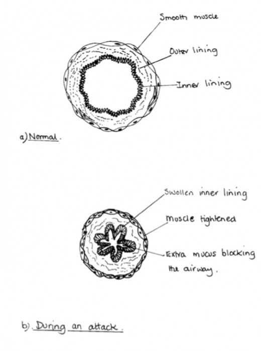 Asthma & its symptoms including a plan diagram of a bronchiole. hubpages