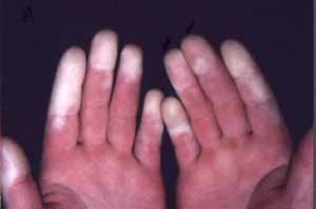 What Your Hands Can Tell You About Your Health HubPages