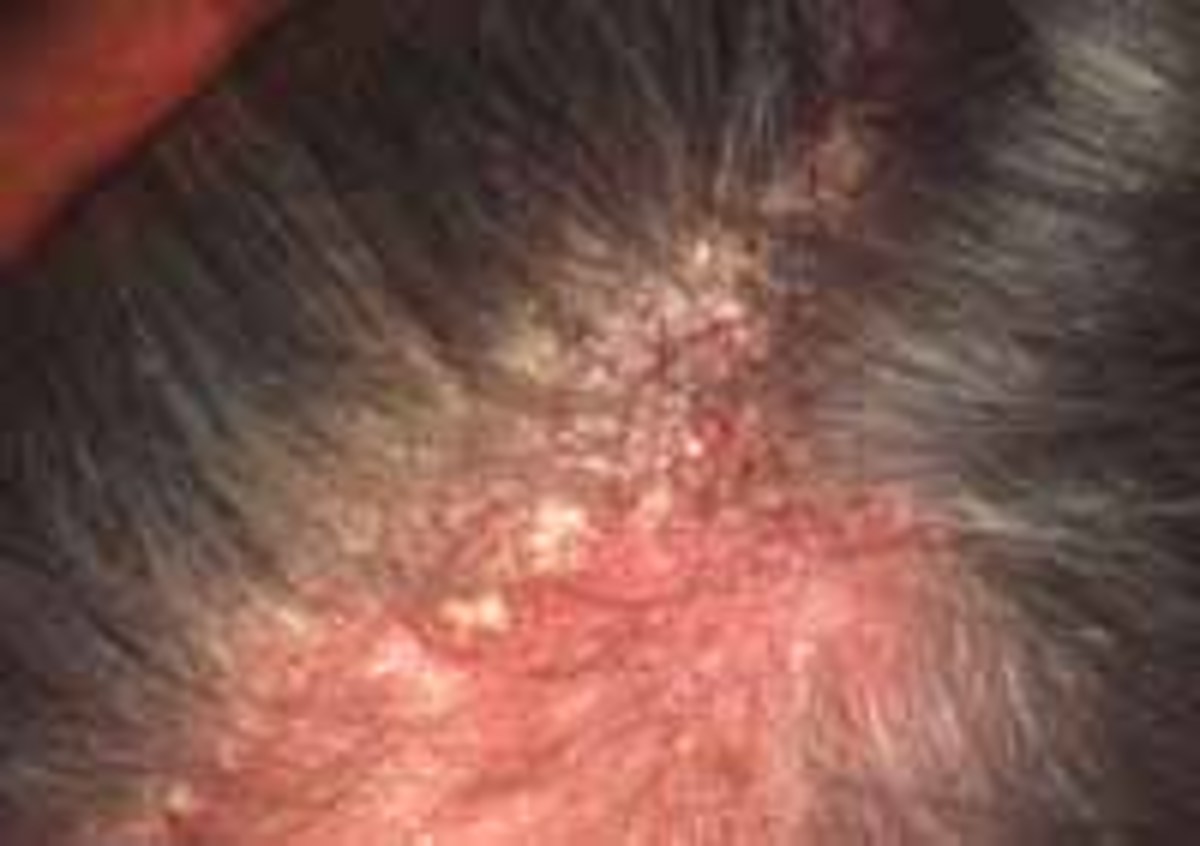 On Dandruff, Seborrhoeic dermatitis, head shaving and