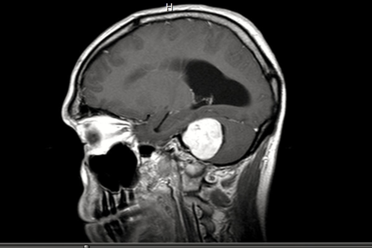 Brain Tumor Diagnosed with an Acoustic Neuroma (part 1) HubPages
