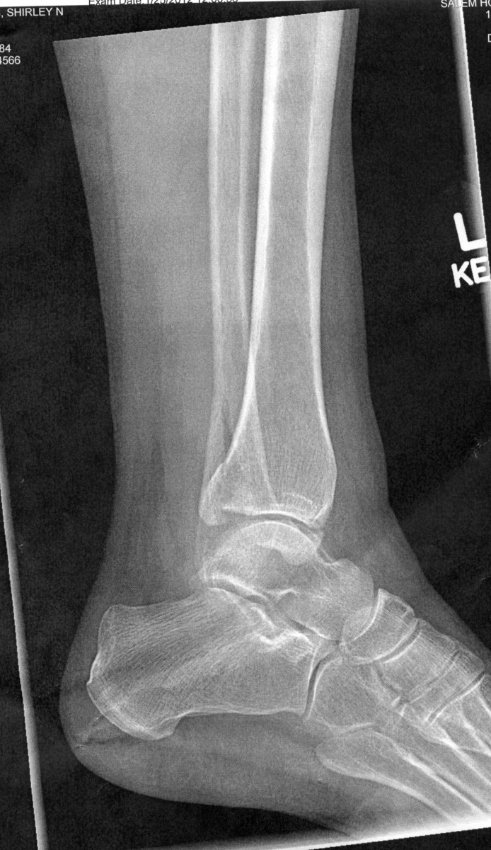 Broken Ankles 101 hubpages