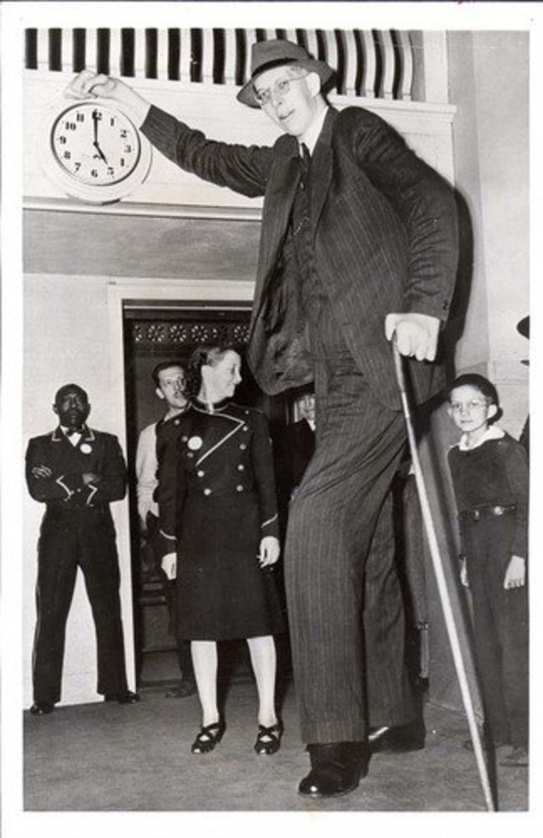 Acromegaly Gigantism; The World's Tallest Human HubPages