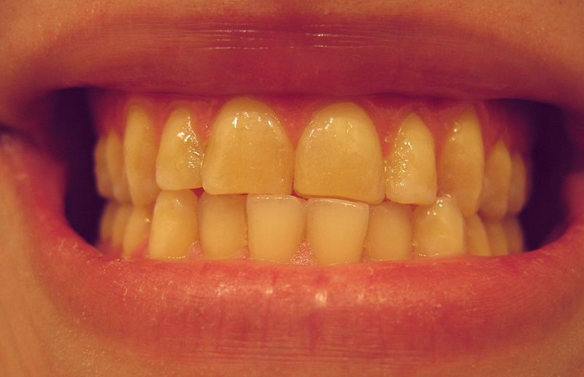 5 Ways to Get Rid of Yellow Teeth HubPages