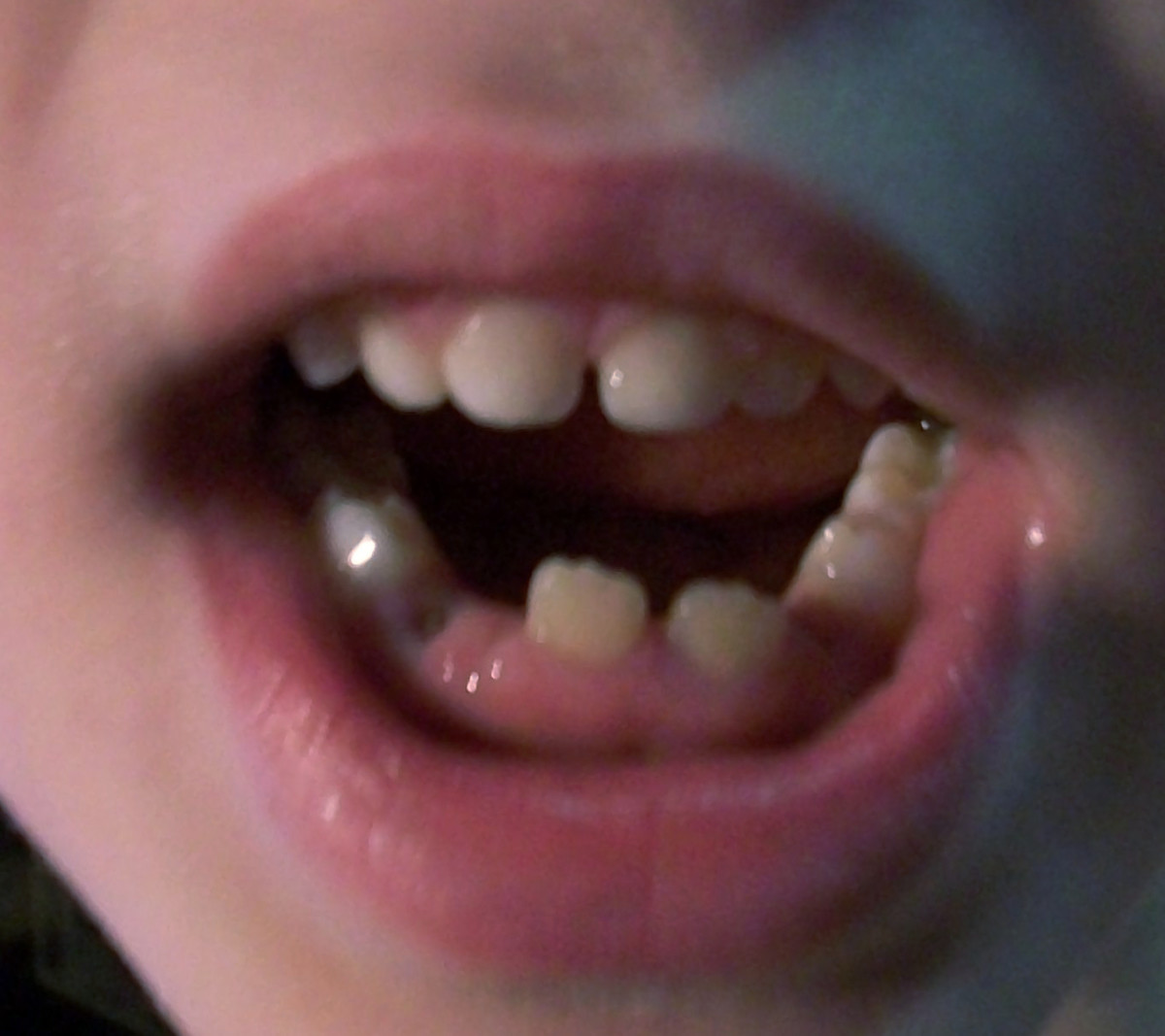 What to Do When Your Young Child Needs Teeth Pulled Patient's Lounge