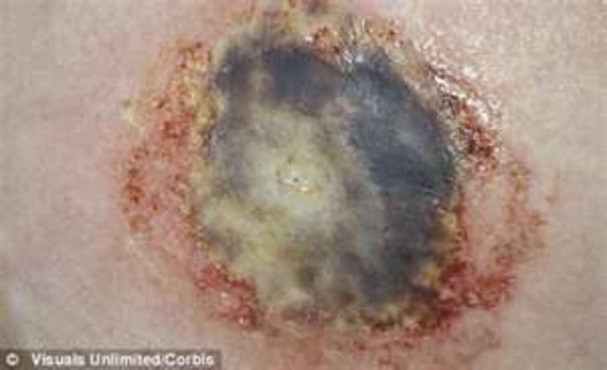 Early Stages of Mersa,MRSA, Aimee Copeland's Brave Fight of Flesh