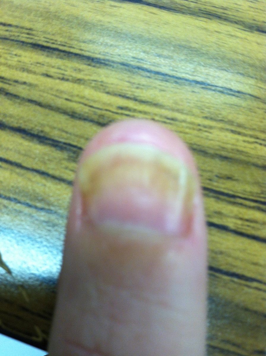 The Ultimate Nail Fungus, Nail Psoriasis, and Nail Bed Separation Cures