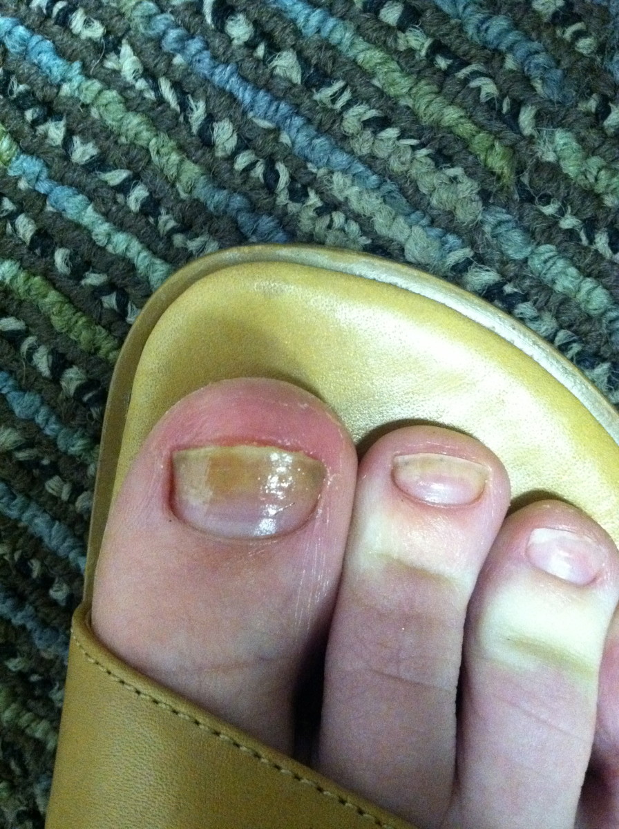 The Ultimate Nail Fungus, Nail Psoriasis, and Nail Bed Separation Cures