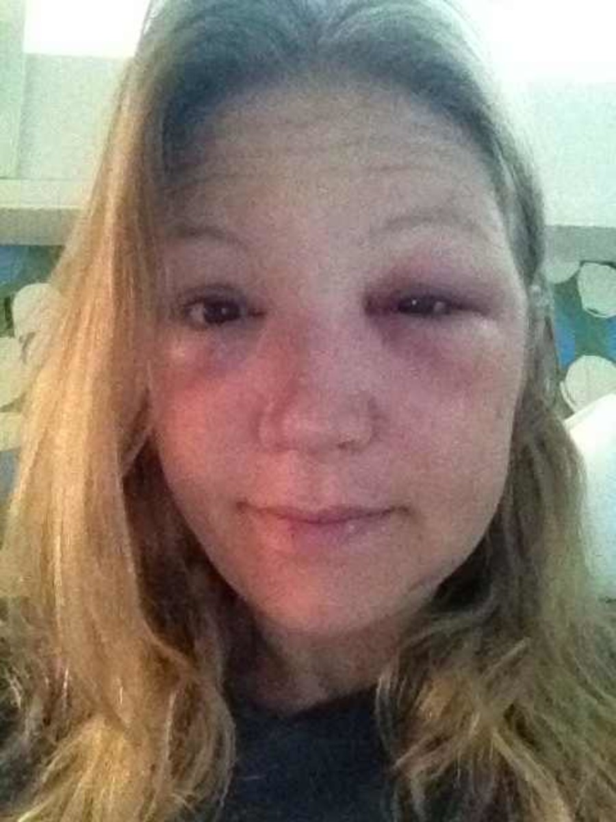 Treatments for a Bee Sting by Eye With a Photo Progression HealDove