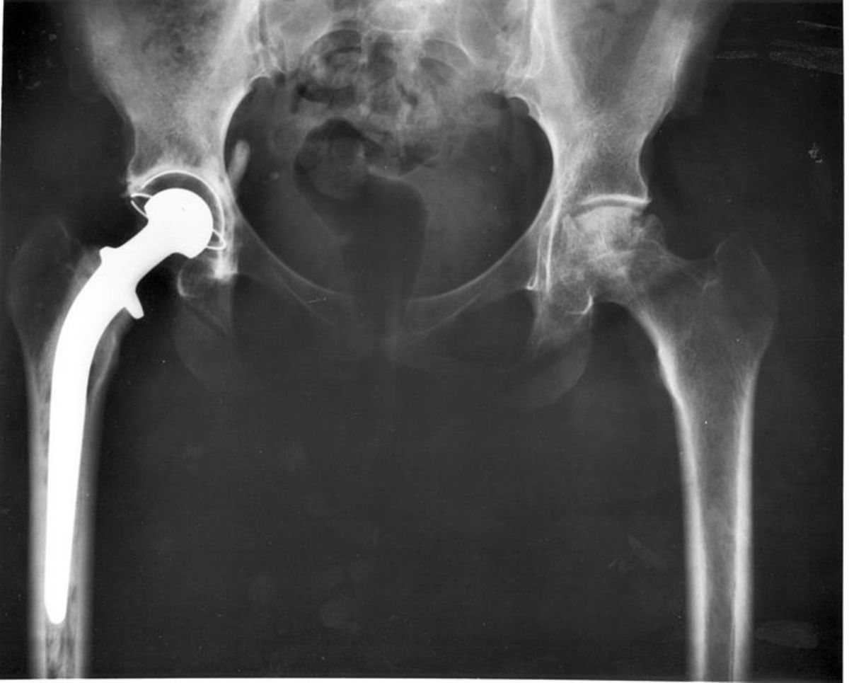 What I Learned About Total Hip Replacement, Avascular Necrosis, and