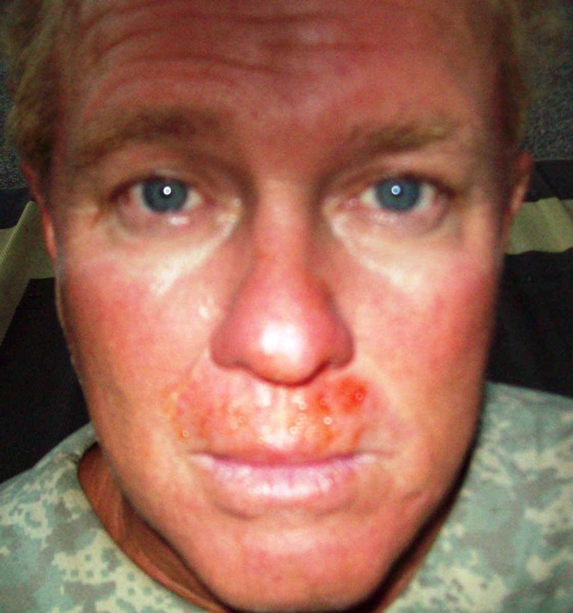 What Are the Causes of Frequent Bloody Noses? HealDove