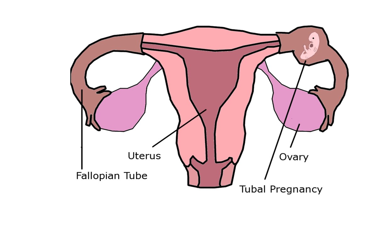 Ectopic Pregnancy Fallopian Tubes Lilianaescaner