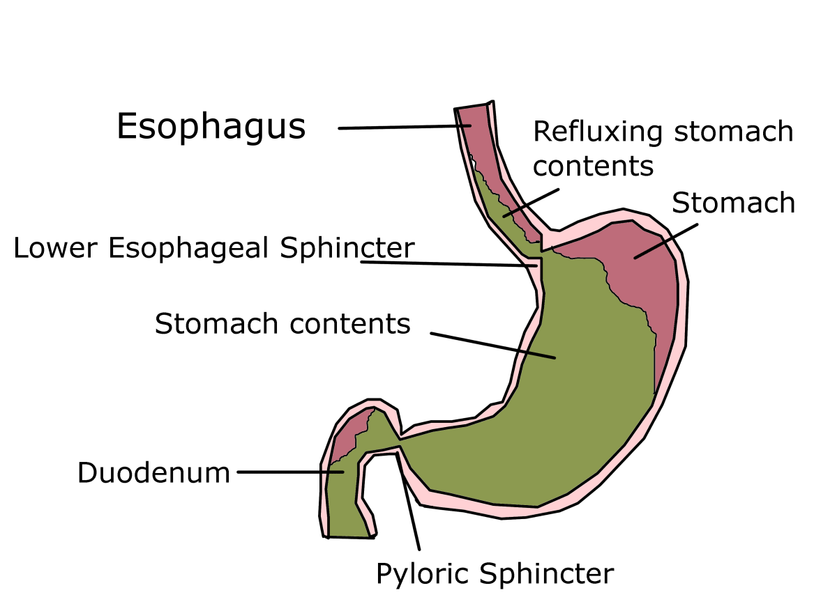 Tips for Preventing Heartburn During Pregnancy hubpages