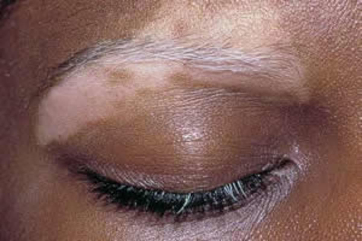 Vitiligo An incurable skin disorder that may be helped naturally