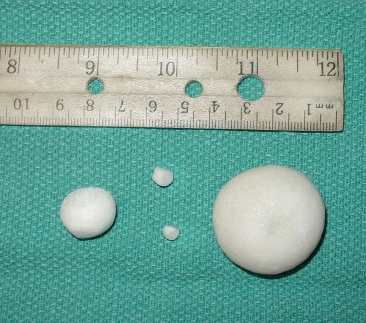 Urinary Tract Infections (UTIs) and Proteus Mirabilis