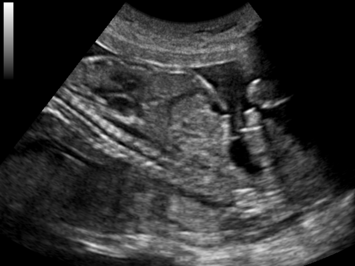 Why it Is Important to Use Gel in Ultrasound HubPages