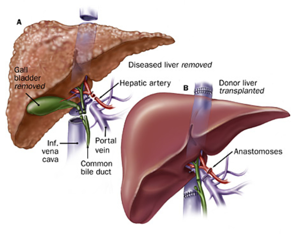 How to Get Ready for a Liver Transplant