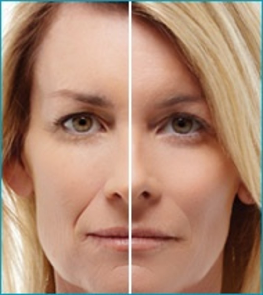 What Causes Laugh Lines and How Do I Get Rid of Them? HubPages