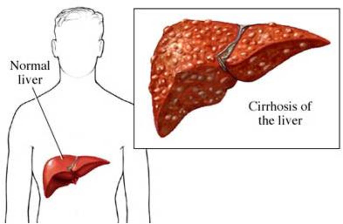 Autoimmune Hepatitis Causes Cirrhosis of the Liver HealthProAdvice