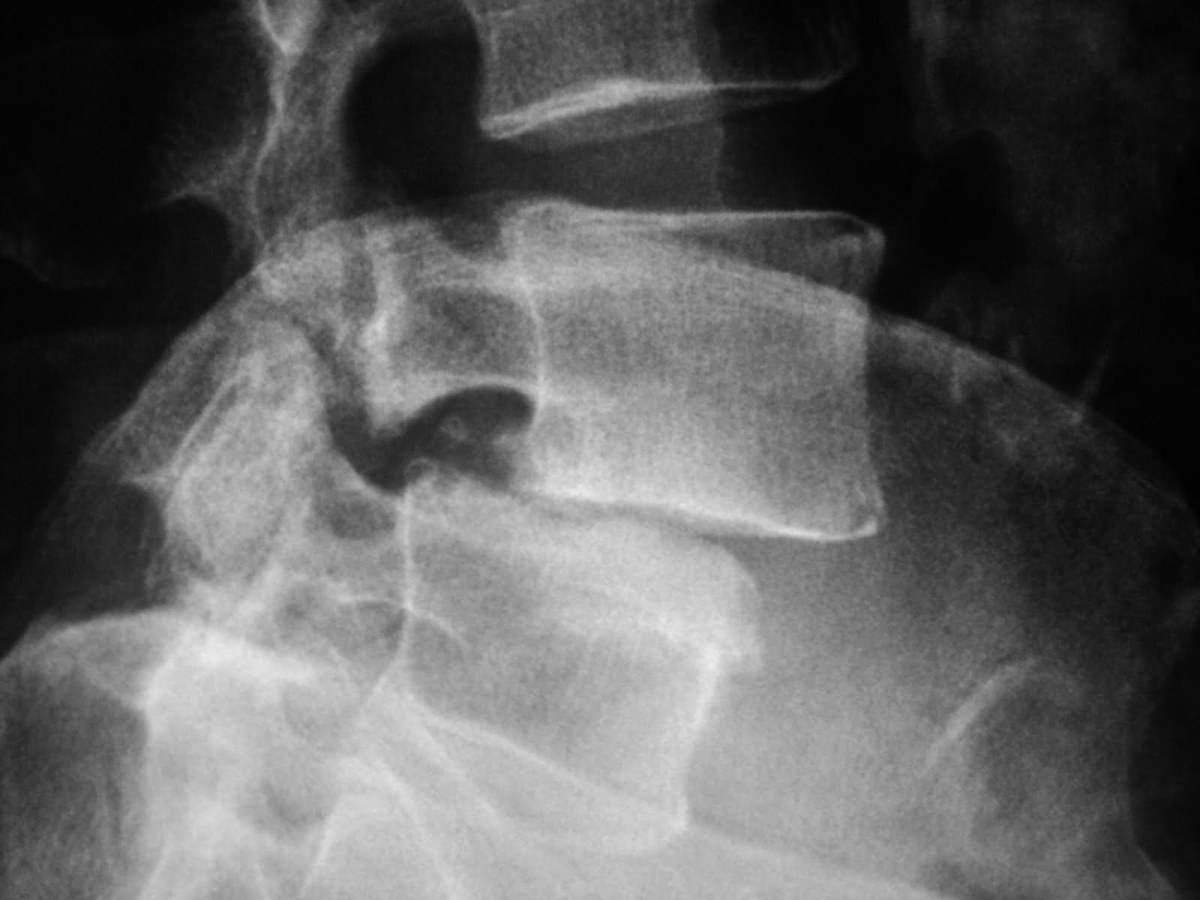 Acute and Chronic Sciatica Causes and removing the pain. hubpages