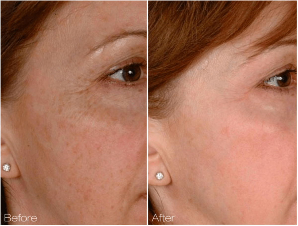 Review of Cutera 2D Skin Rejuvenation Procedure HubPages