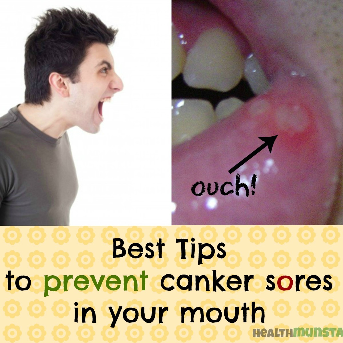 Pain Relief For Canker Sores & Mouth Ulcers Natural And Over The