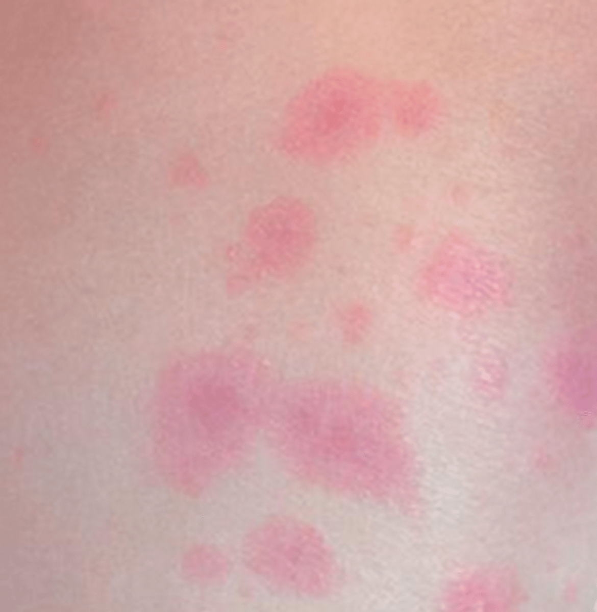 HIV Rash Images, Symptoms, Location, and Treatment HubPages