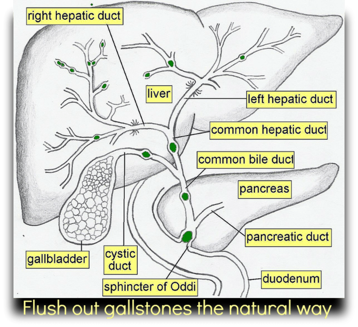What to Expect Before, During, and After a Gallbladder Surgery HubPages