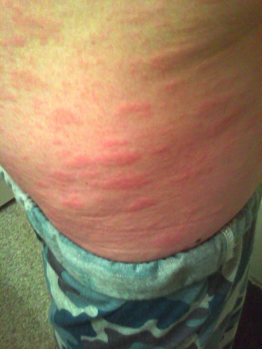 Pityriasis Rosea My Strange FullBody Rash HealDove