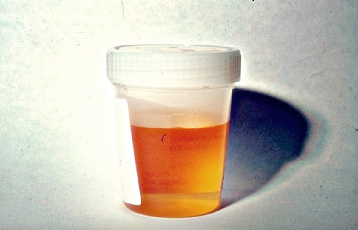 Orange Urine Causes, Symptoms, Diagnosis,Treatment