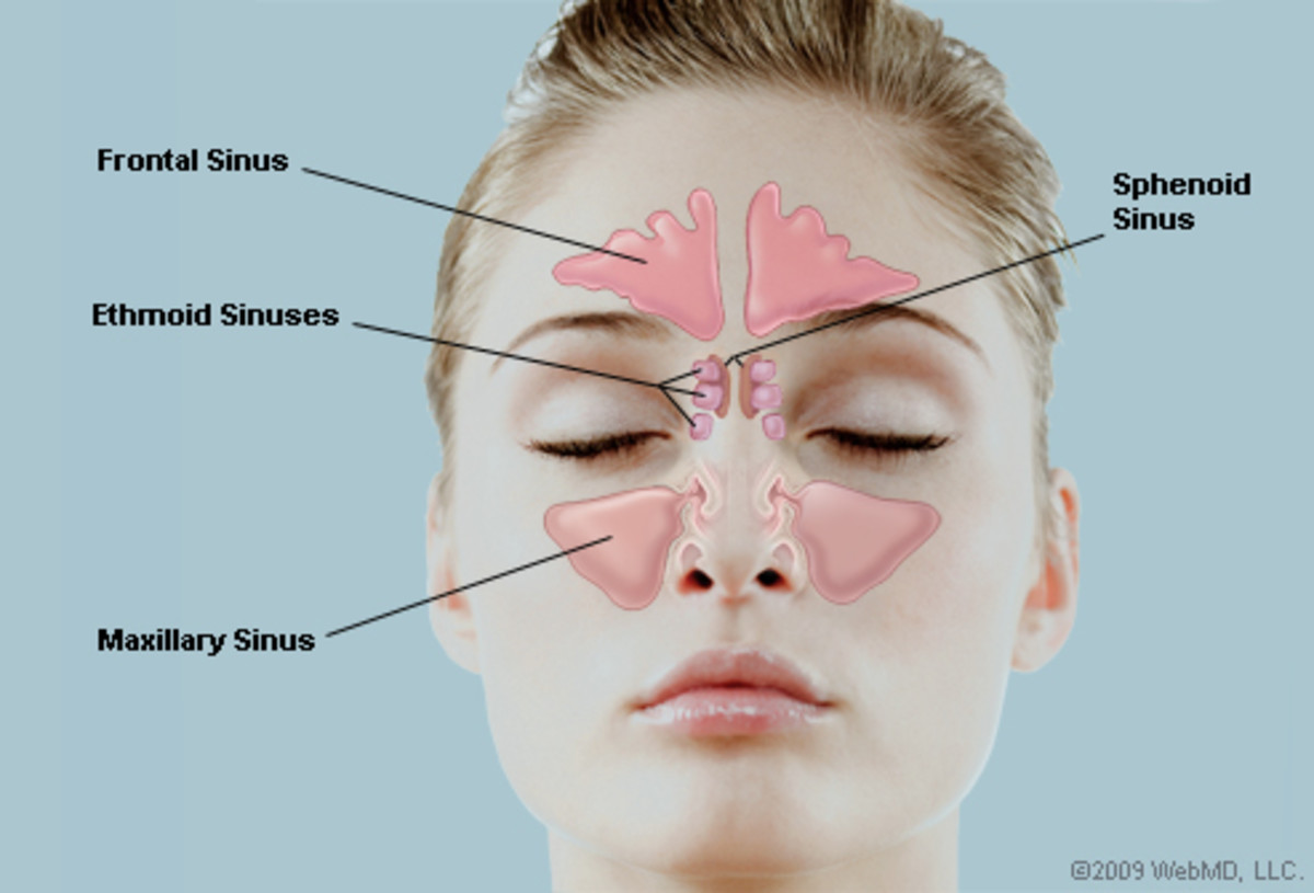 Sinusitis A very lowering and painful infection. HubPages