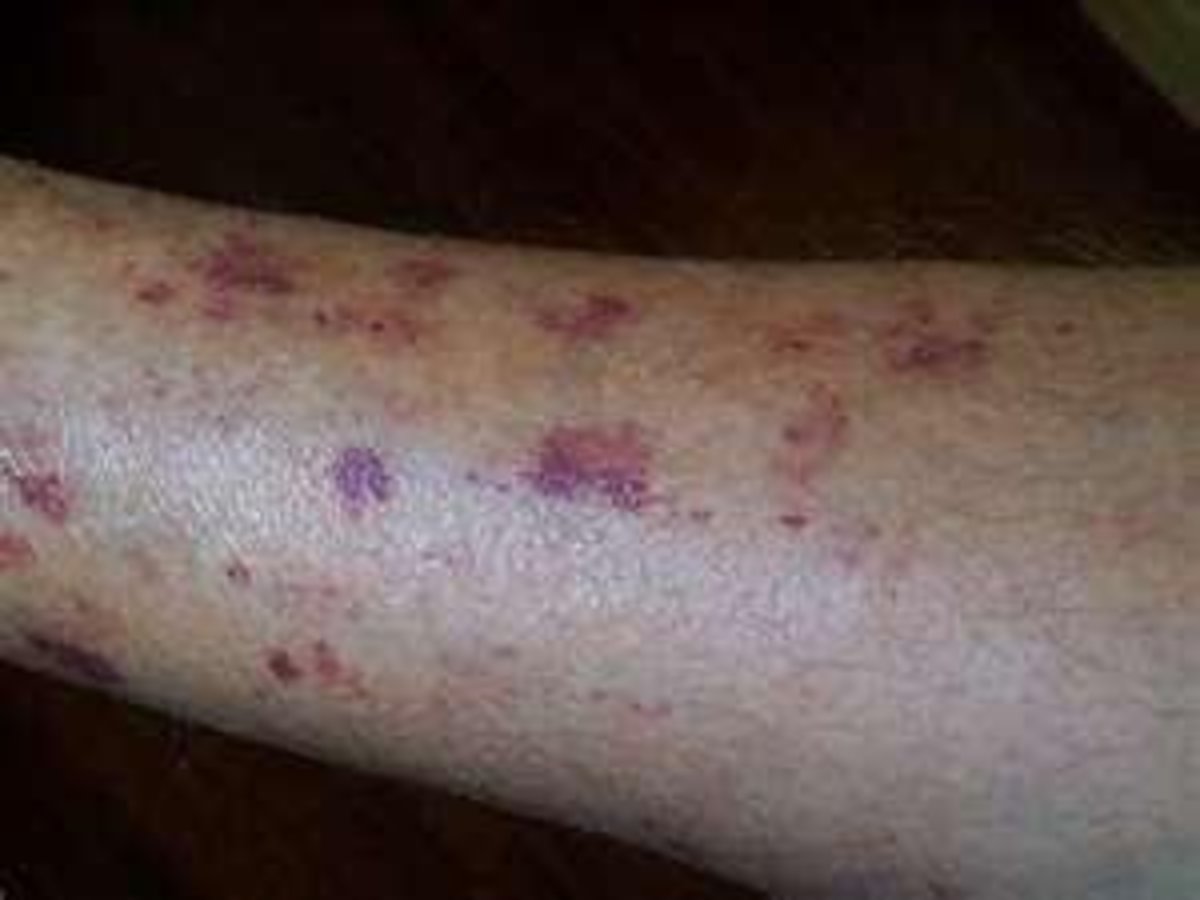 Causes of senile purpura Information and symptoms of senile bleeding