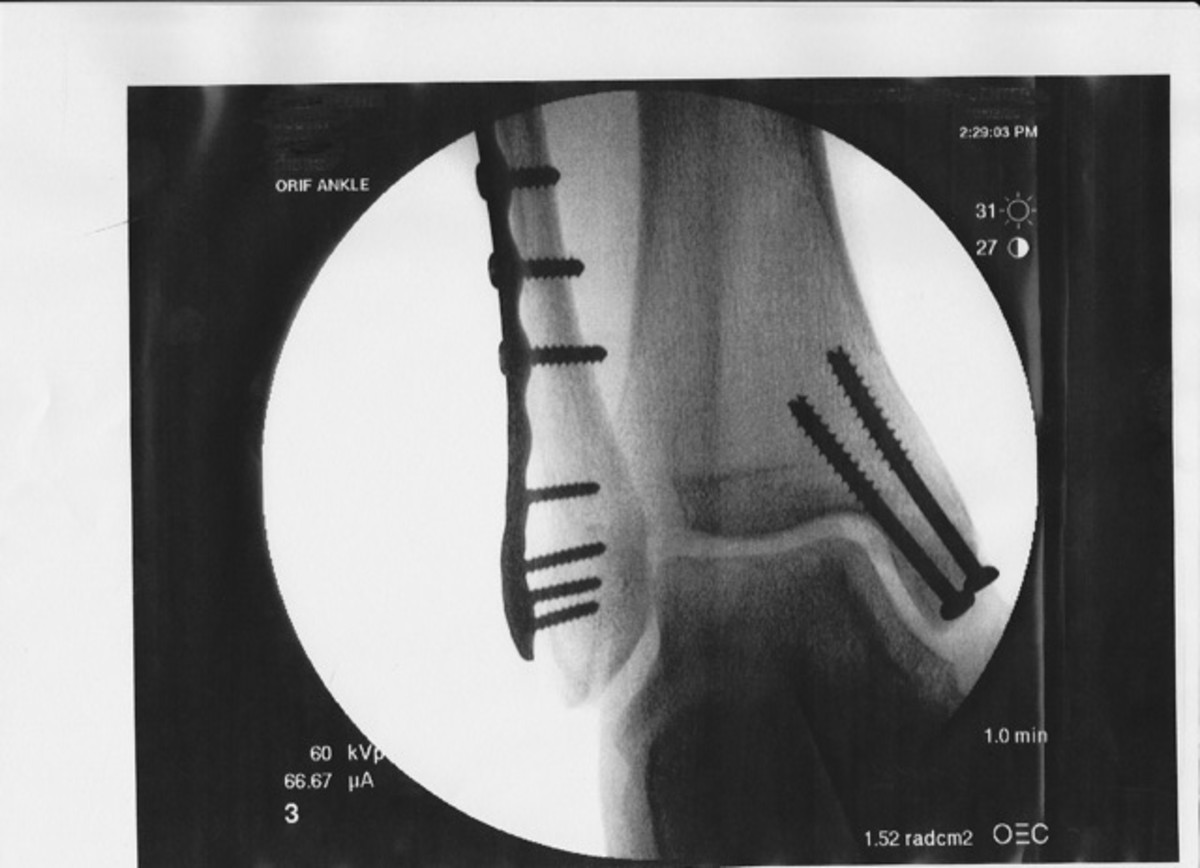 Broken Ankle Screw and Plate Removal Surgery Yes or No? Healdove