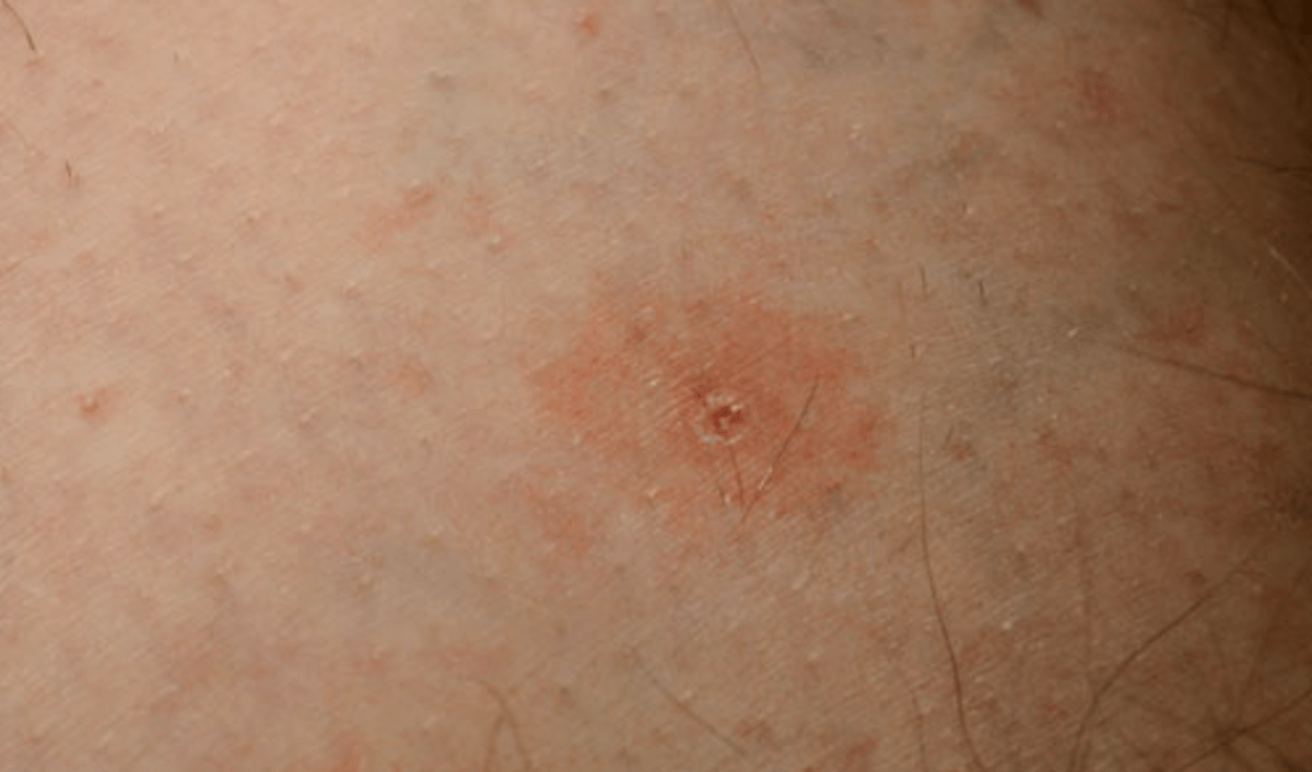 Tick Bite Pictures, Symptoms, Causes, Treatment hubpages