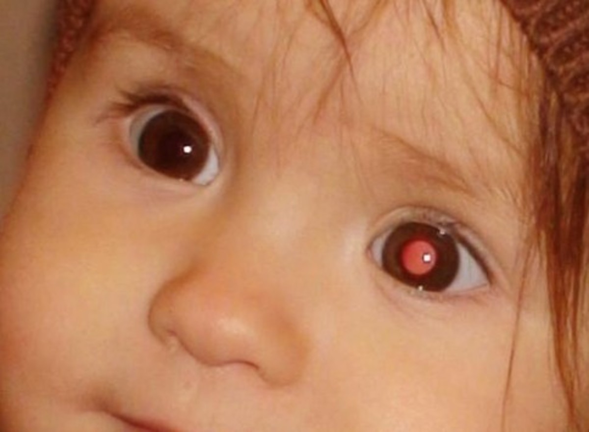 Retinoblastoma Pictures, Treatment, Causes, Stages, Symptoms HubPages