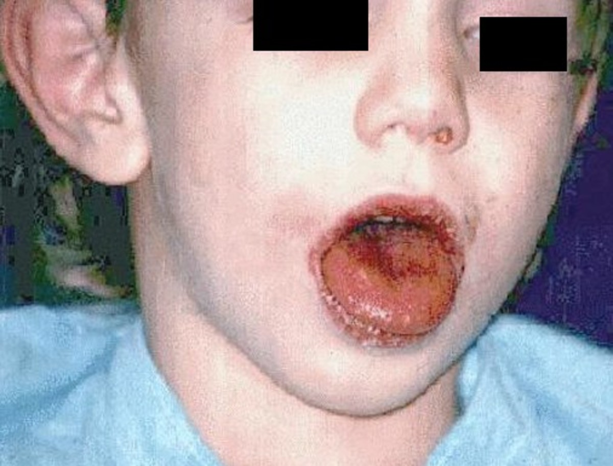 Kawasaki Disease Pictures, Symptoms, Contagious, Causes, Treatment